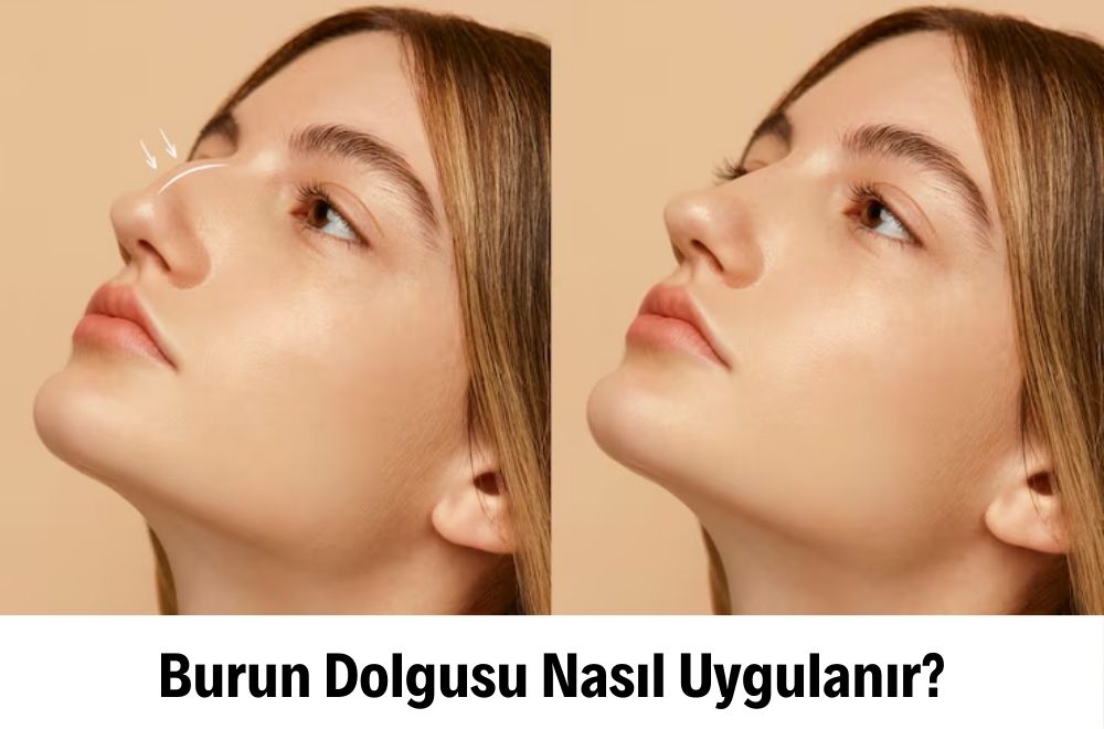 Burun Dolgusu Burun Dolgusu