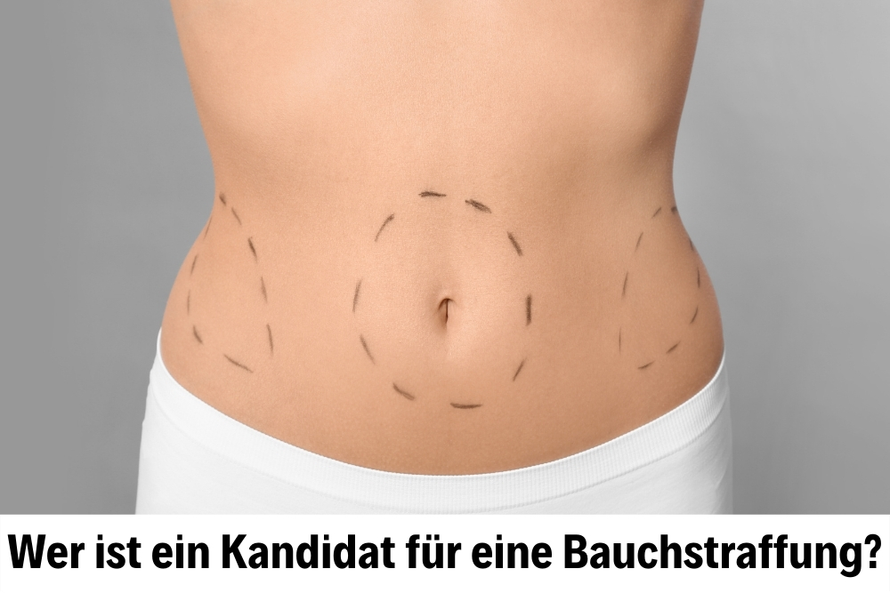 Bauchstraffung Bauchstraffung